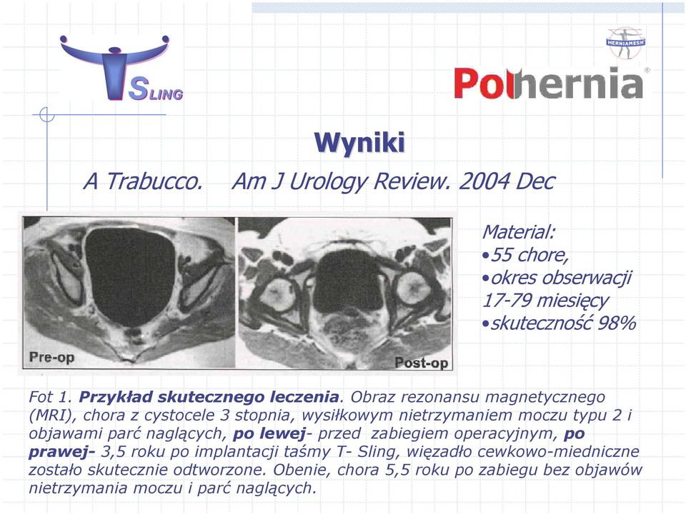 Obraz rezonansu magnetycznego (MRI), chora z cystocele 3 stopnia, wysiłkowym nietrzymaniem moczu typu 2 i objawami parć