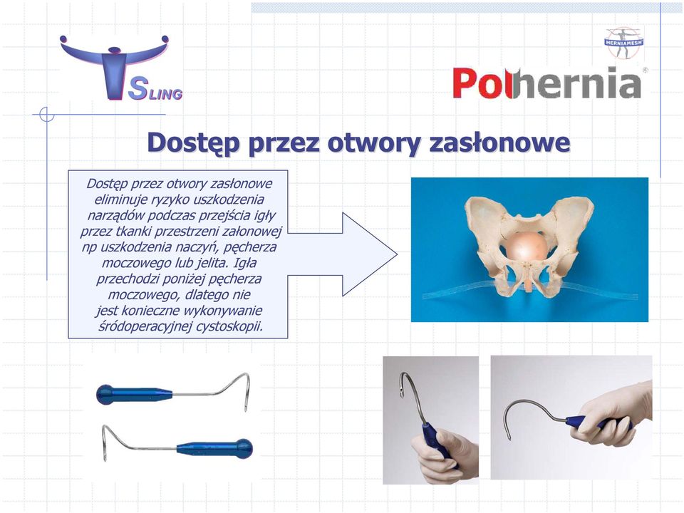 np uszkodzenia naczyń, pęcherza moczowego lub jelita.