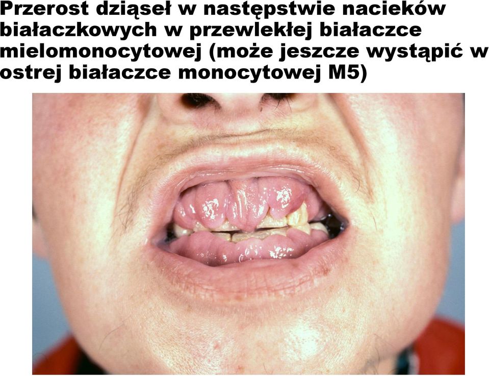 białaczce mielomonocytowej (może