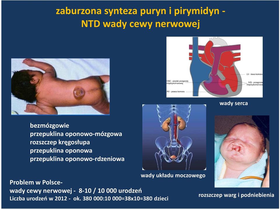 oponowo-rdzeniowa Problem w Polscewady cewy nerwowej - 8-10 / 10 000 urodzeń Liczba