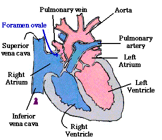 Krążenie płodowe w warunkach prawidłowych Krew z prawego przedsionka (RA) wpływa do lewego przez otwór owalny (FO) z zastawką omijając krążenie płucne