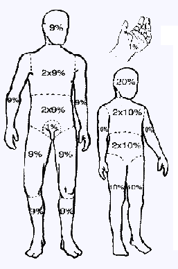 procentowe obszary reguła dłoni: służy do oceny powierzchni oparzeń u osób dorosłych, według niej powierzchnia dłoni osoby oparzonej stanowi 1% całkowitej powierzchni