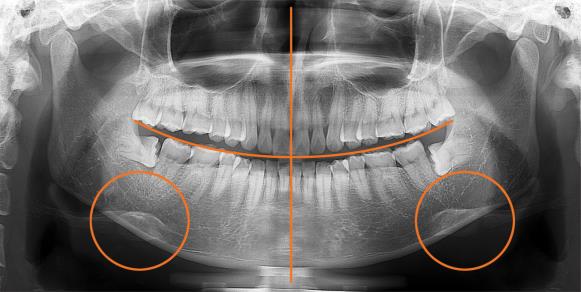 Zęby górne i dolne zagryzione w rowku zagryzaka. 2 Wyrównanie w płaszczyźnie strzałkowej 1 Wyrównaj środek głowy pacjenta zgodnie z wiązką lasera. 2.W razie potrzeby delikatnie obróć głowę pacjenta w celu dostosowania.
