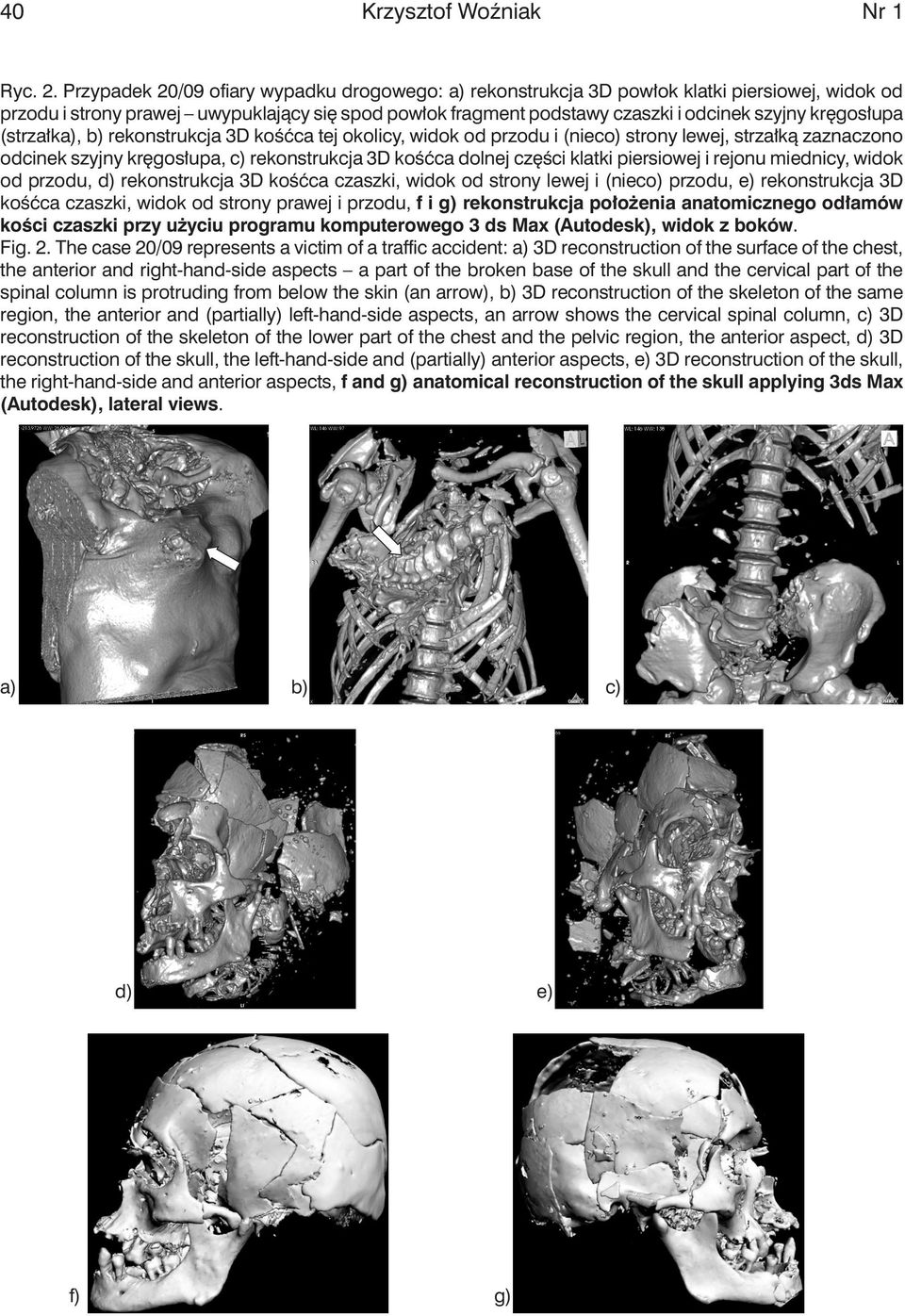 kręgosłupa (strzałka), b) rekonstrukcja 3D kośćca tej okolicy, widok od przodu i (nieco) strony lewej, strzałką zaznaczono odcinek szyjny kręgosłupa, c) rekonstrukcja 3D kośćca dolnej części klatki
