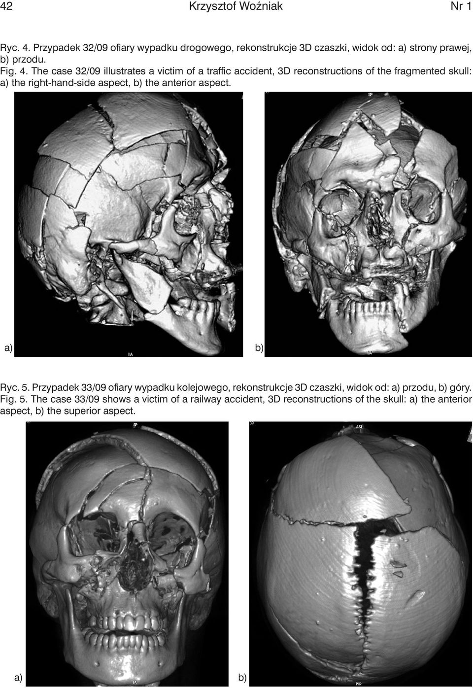 The case 32/09 illustrates a victim of a traffic accident, 3D reconstructions of the fragmented skull: a) the right-hand-side aspect, b) the