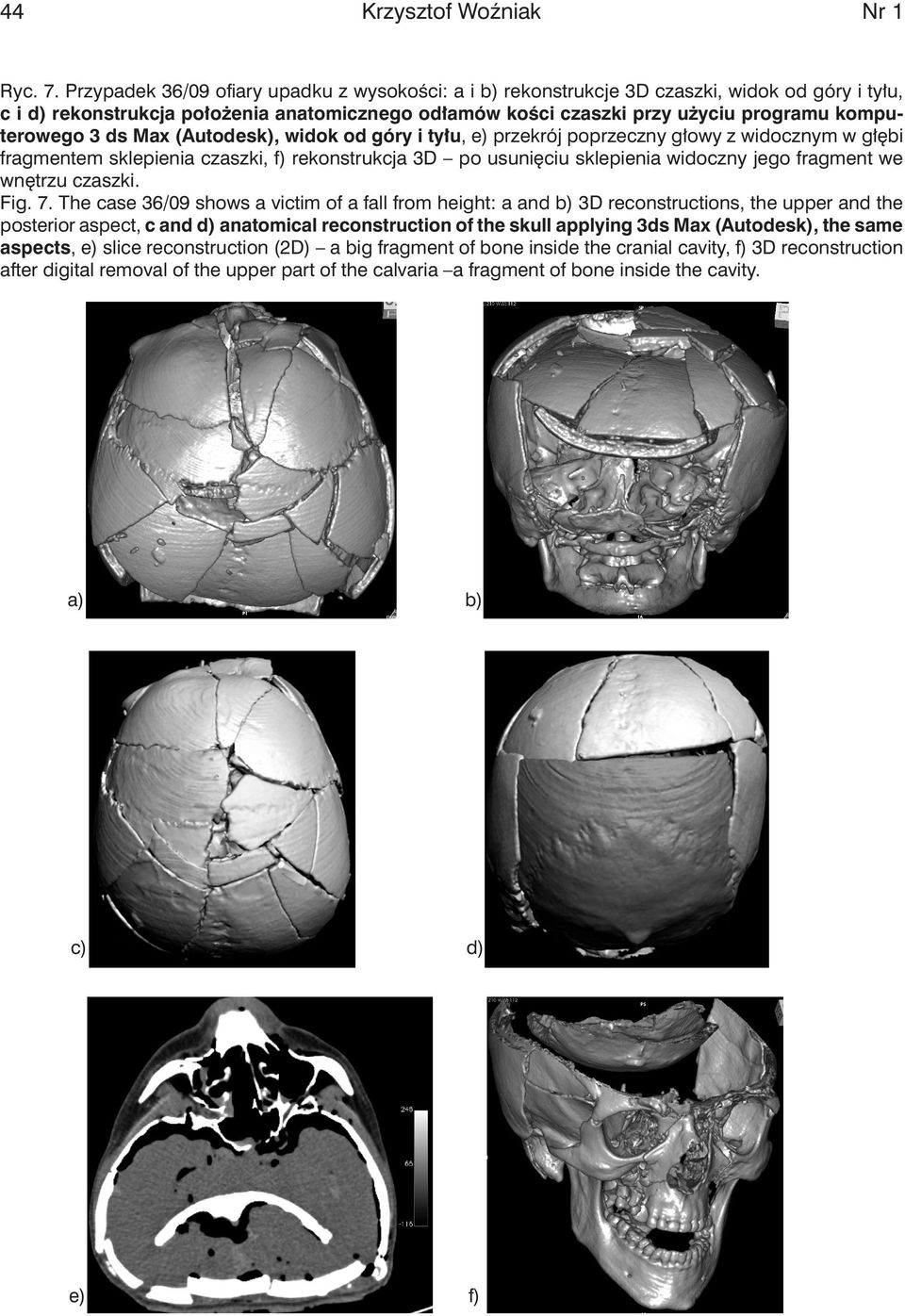 3 ds Max (Autodesk), widok od góry i tyłu, e) przekrój poprzeczny głowy z widocznym w głębi fragmentem sklepienia czaszki, f) rekonstrukcja 3D po usunięciu sklepienia widoczny jego fragment we