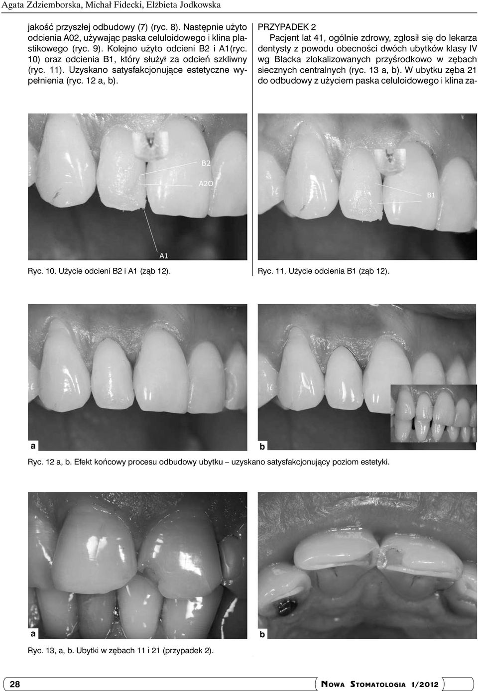 PRZYPADEK 2 Pcjent lt 41, ogólnie zdrowy, zgłosił się do lekrz dentysty z powodu oecności dwóch uytków klsy IV wg Blck zloklizownych przyśrodkowo w zęch siecznych centrlnych (ryc. 13, ).