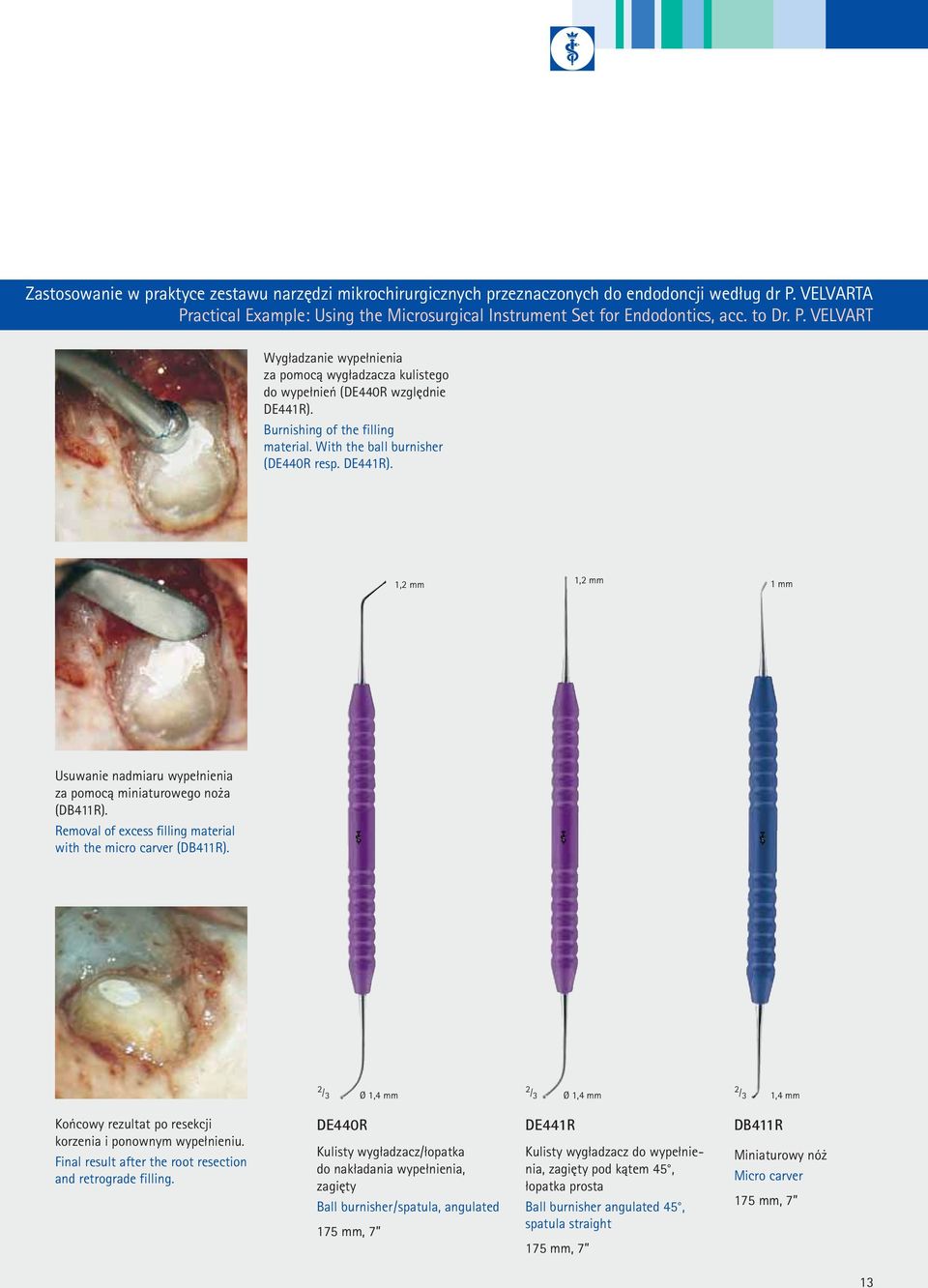 Removal of excess filling material with the micro carver (DB411R). 2 /3 2 Ø 1,4 mm /3 2 Ø 1,4 mm /3 1,4 mm Końcowy rezultat po resekcji korzenia i ponownym wypełnieniu.