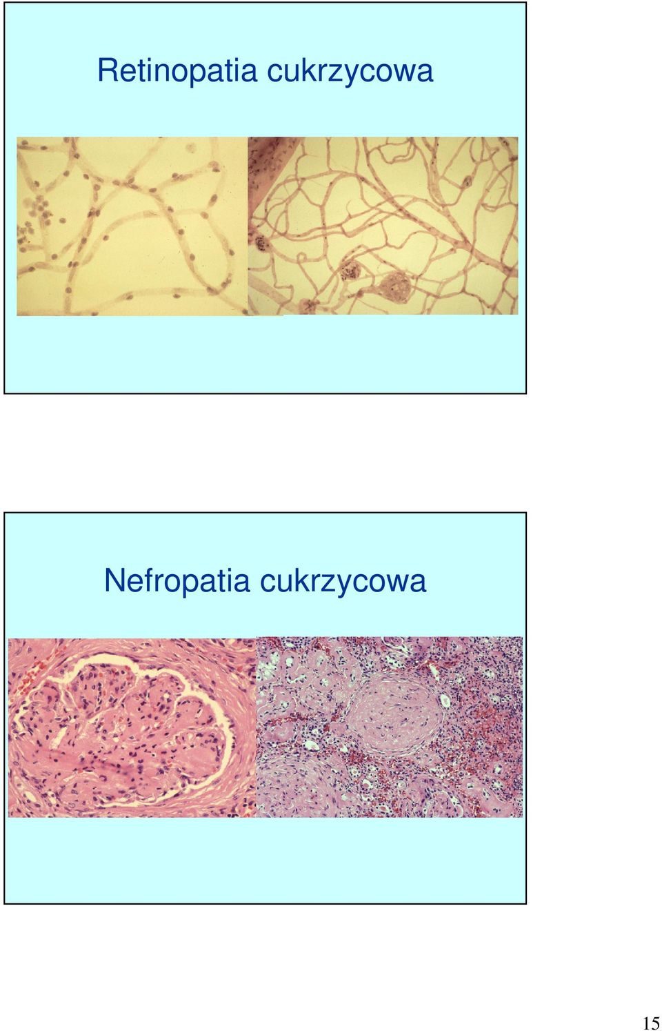 Nefropatia 