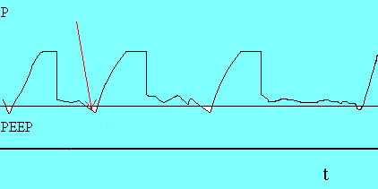 Wentylacja wspomagana (PTV, A/C, SIPPV)