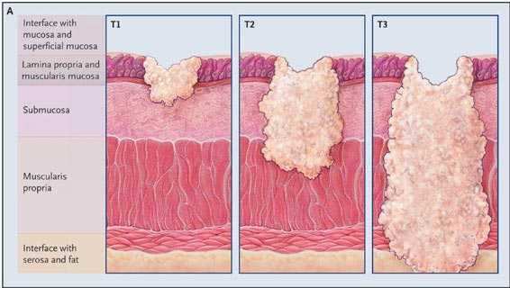 Typy histologiczne raka j.