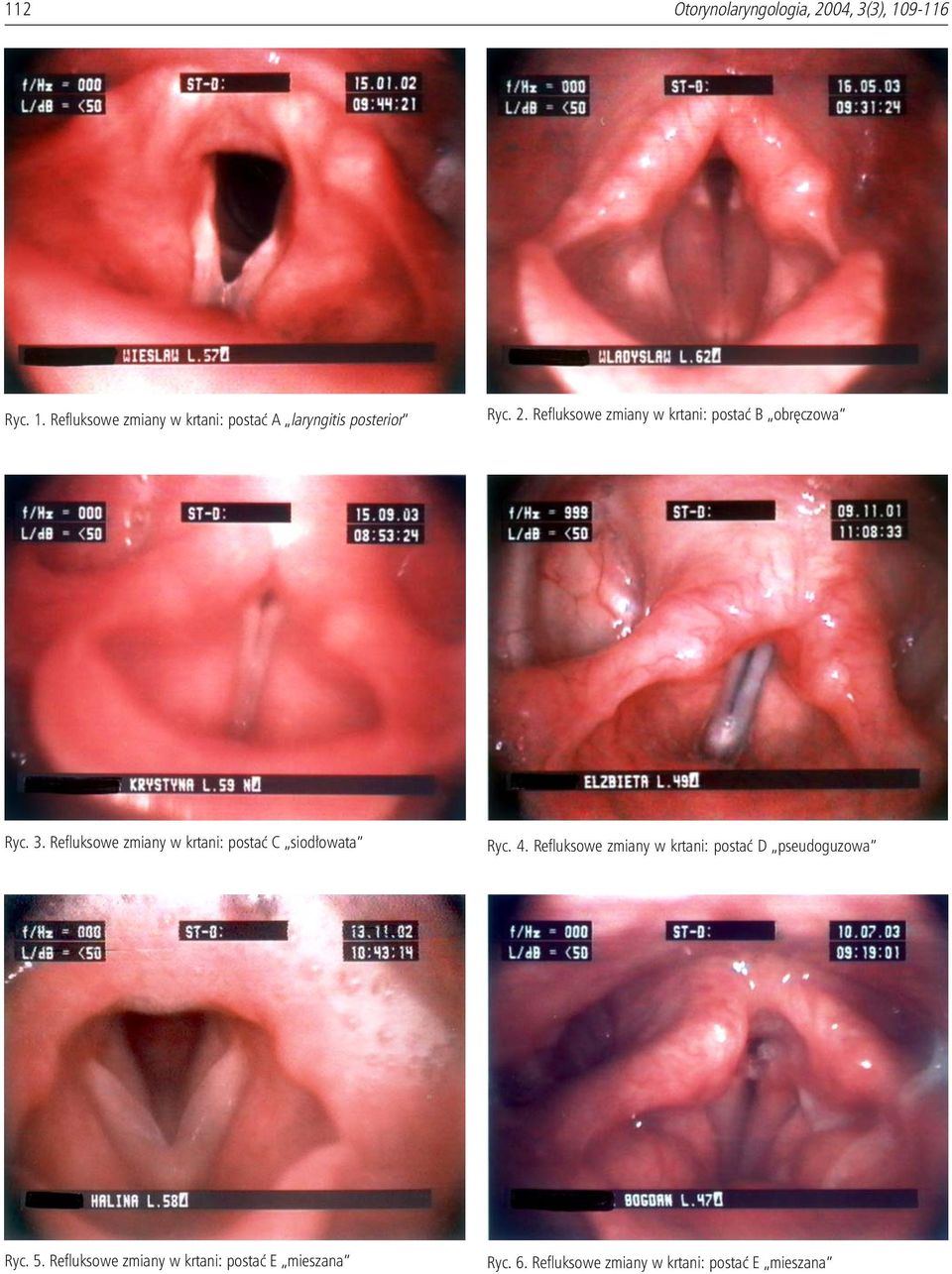 Refluksowe zmiany w krtani: postaæ B obrêczowa Ryc. 3.