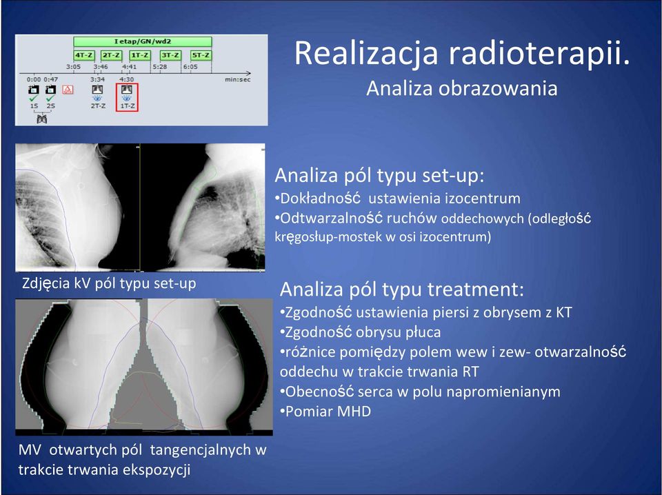 kręgosłup-mostek w osi izocentrum) Zdjęcia kv pól typu set-up Analiza pól typu treatment: Zgodność ustawienia piersi z