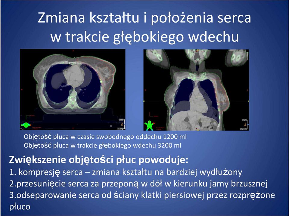 powoduje: 1. kompresję serca zmiana kształtu na bardziej wydłużony 2.