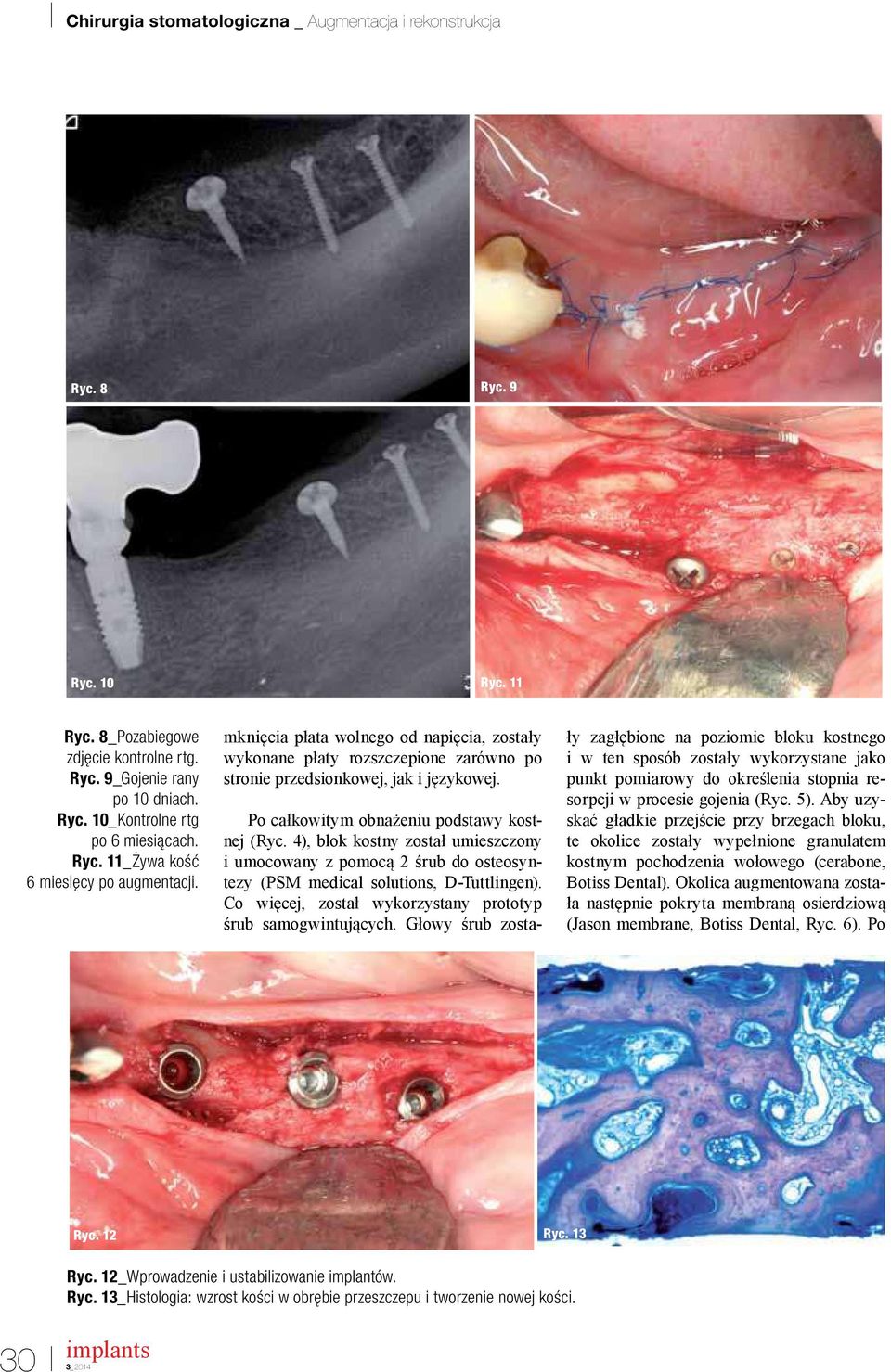 4), blok kostny został umieszczony i umocowany z pomocą 2 śrub do osteosyntezy (PSM medical solutions, D-Tuttlingen). Co więcej, został wykorzystany prototyp śrub samogwintujących.