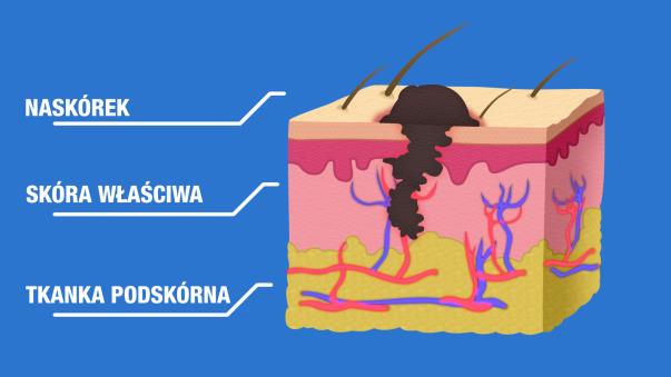 ultrafioletowym Bardzo agresywny wzrost Wczesne i liczne przerzuty, trudne w leczeniu farmakologicznym Szybko przechodzi z choroby miejscowej (rozwijającej