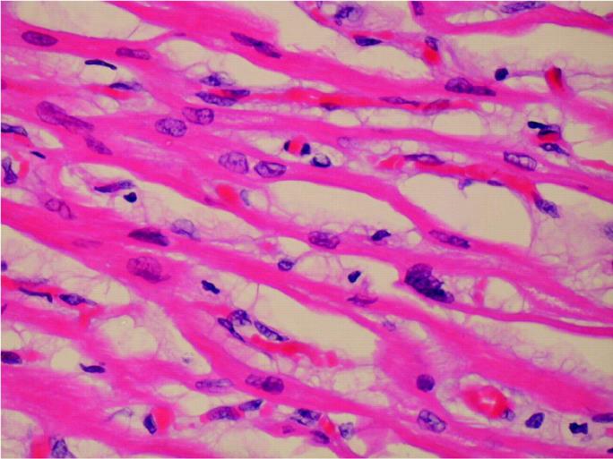 Zmiany strukturalne - miokardium Objętości komórki Kumulacja uszkodzeń DNA Ilości kardiomiocytów Uszkodzenie