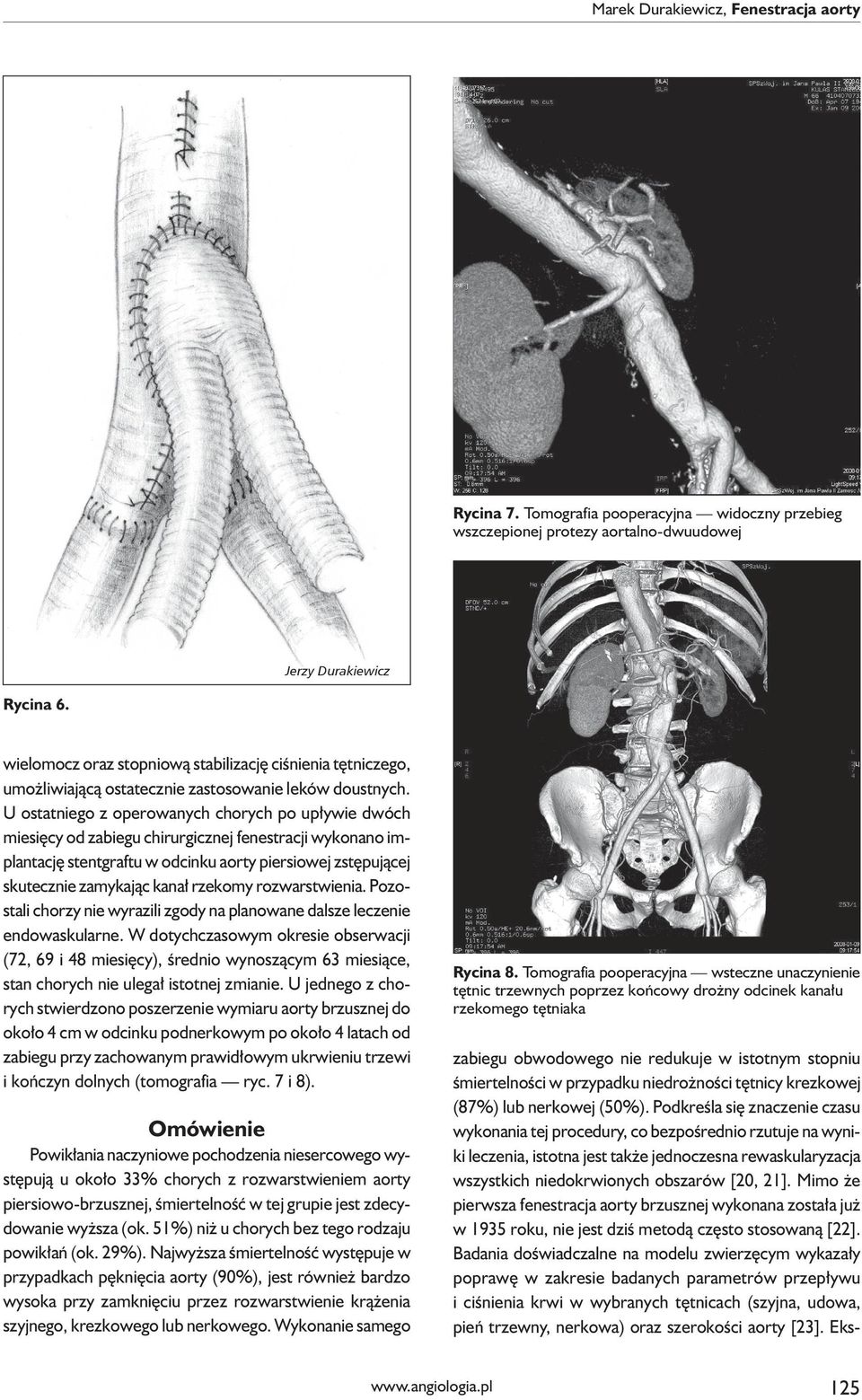 U ostatniego z operowanych chorych po upływie dwóch miesięcy od zabiegu chirurgicznej fenestracji wykonano implantację stentgraftu w odcinku aorty piersiowej zstępującej skutecznie zamykając kanał