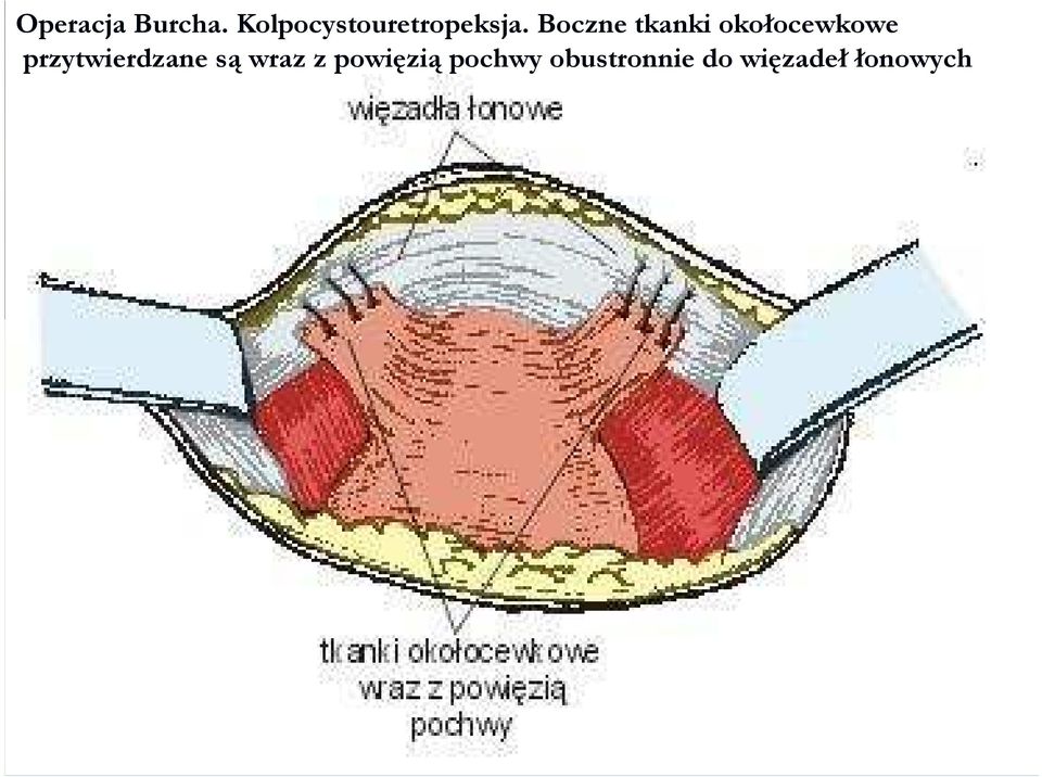 Boczne tkanki okołocewkowe