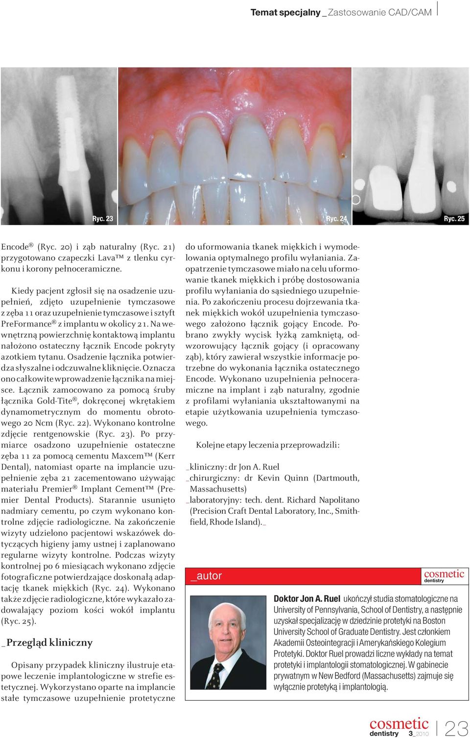 Na wewnętrzną powierzchnię kontaktową implantu nałożono ostateczny łącznik Encode pokryty azotkiem tytanu. Osadzenie łącznika potwierdza słyszalne i odczuwalne kliknięcie.