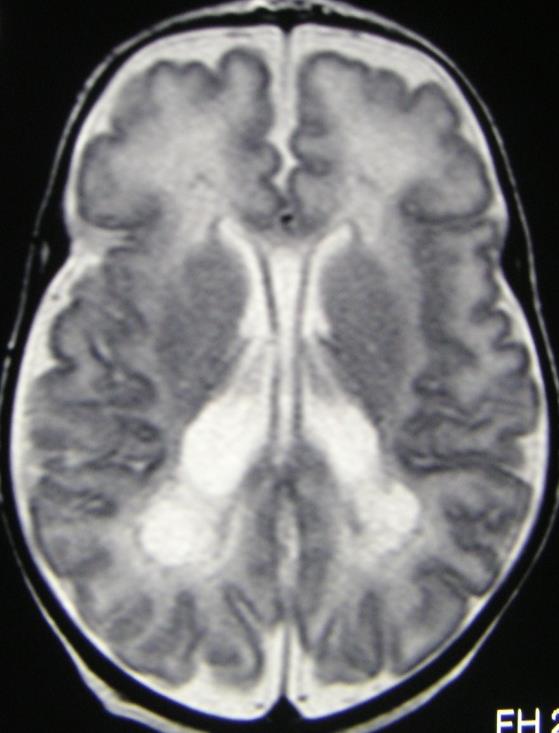 Zakład Diagnostyki Obrazowej, Clamart, Francja czołowa T1 strzałkowa T1 poprzeczna T2 Leukomalcja okołokomorowa (PVL) u wcześniaka MR w 34 t.c:.