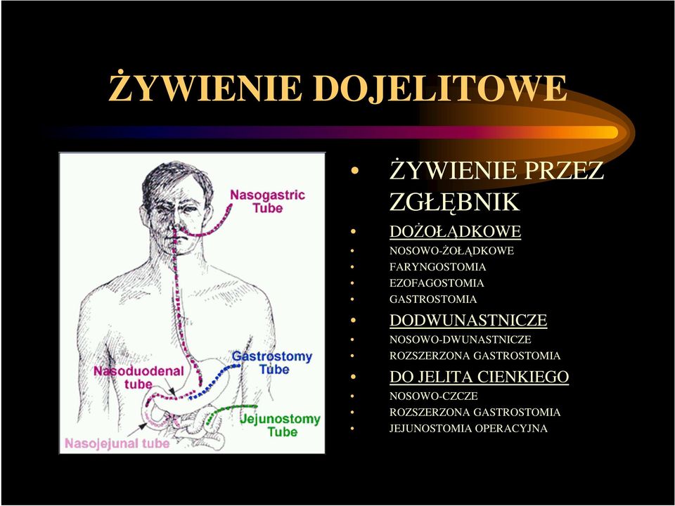 DODWUNASTNICZE NOSOWO-DWUNASTNICZE ROZSZERZONA GASTROSTOMIA DO