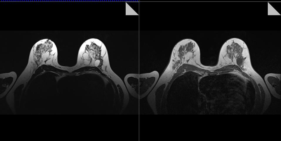 MRI: w obrazach T1 i T2 zależnych widoczna torbiel.