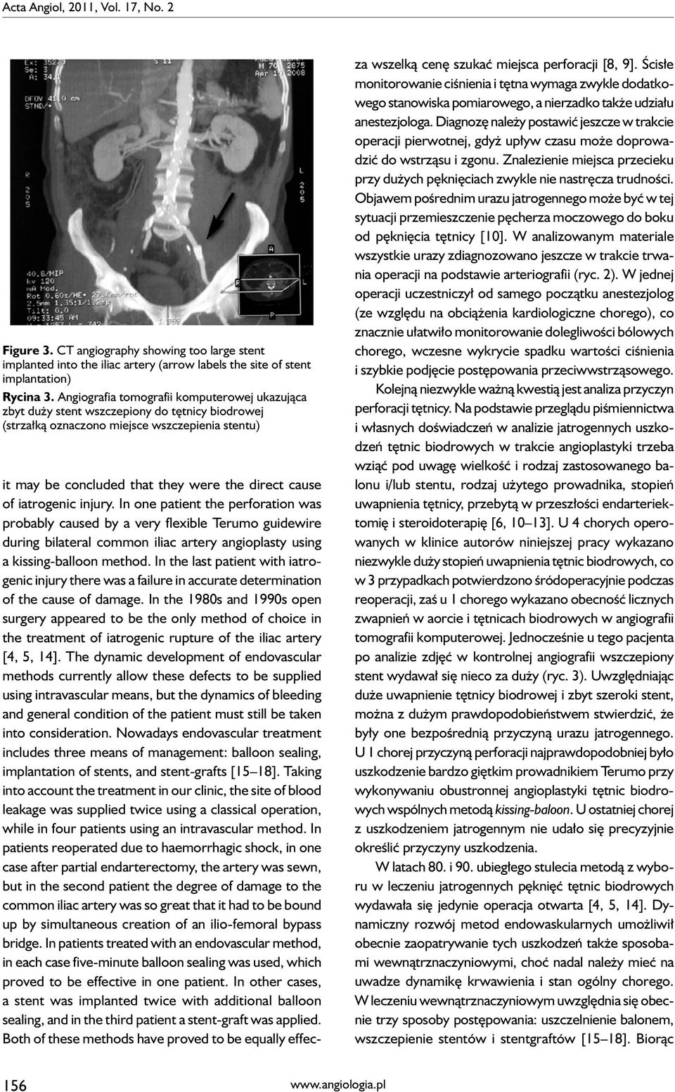 iatrogenic injury. In one patient the perforation was probably caused by a very flexible Terumo guidewire during bilateral common iliac artery angioplasty using a kissing-balloon method.