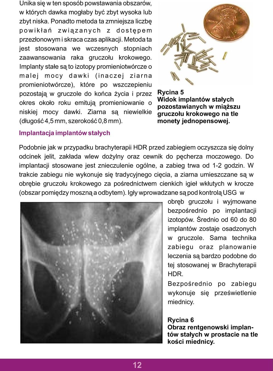 Implanty sta³e s¹ to izotopy promieniotwórcze o malej mocy dawki (inaczej ziarna promieniotwórcze), które po wszczepieniu pozostaj¹ w gruczole do koñca ycia i przez okres oko³o roku emituj¹