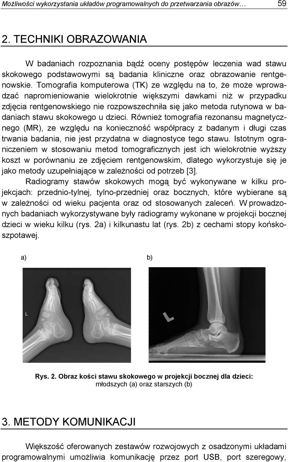 Tomografia komputerowa (TK) ze względu na to, że może wprowadzać napromieniowanie wielokrotnie większymi dawkami niż w przypadku zdjęcia rentgenowskiego nie rozpowszechniła się jako metoda rutynowa w