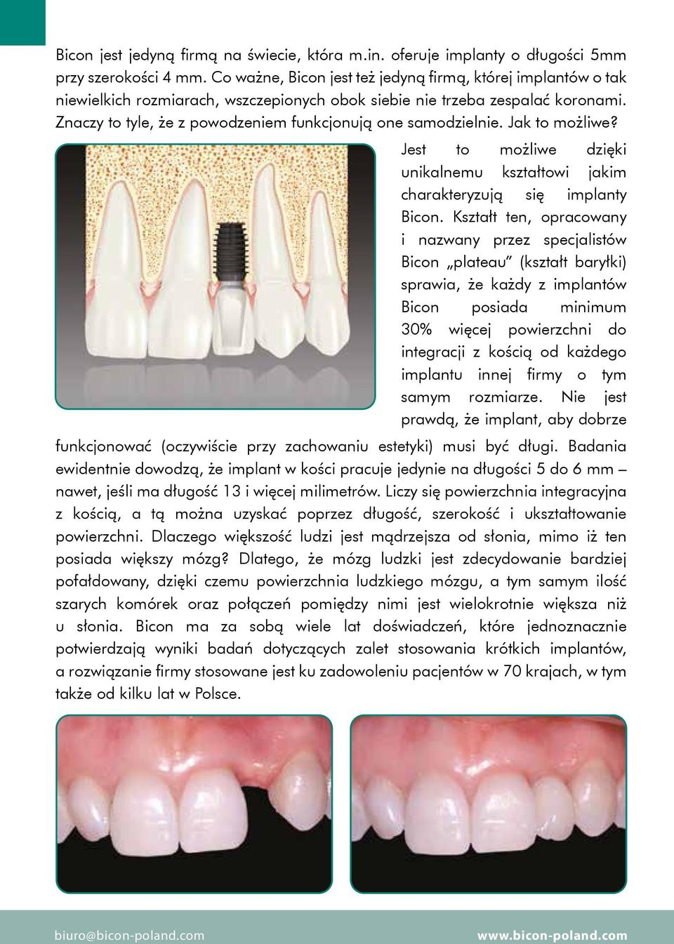 Znaczy to tyle, że z powodzeniem funkcjonują one samodzielnie. Jak to możliwe? Jest to możliwe dzięki unikalnemu kształtowi jakim charakteryzują się implanty Bicon.
