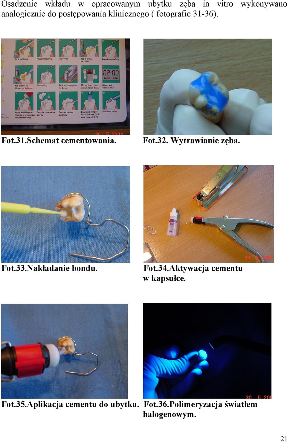 Wytrawianie zęba. Fot.33.Nakładanie bondu. Fot.34.Aktywacja cementu w kapsułce.