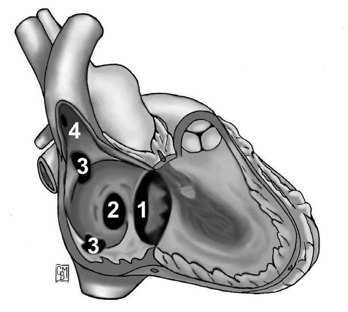 3. ASD typu sinus venosus (ok.