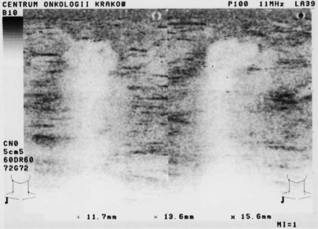 36 Ryc. 3. Zmiana podejrzana (BIRADS V) obraz ultrasonograficzny raka piersi głowicy 12 MHz (aparat Falcon 2101 EXL, B-K Medical A/S, Herlev, Denmark).