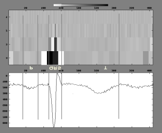 2.3. Pomiar szumów w górnych zakresach częstotliwości Przyjęto, że sygnał linii izoelektrycznej (pomiędzy końcem załamka P a początkiem zespołu QRS, lub ok.