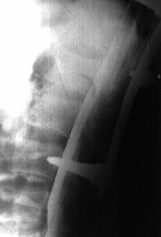 Radiologiczna ocena stopnia odtworzenia wysokości i przemieszczenia... 147 a) b) Ryc. 3.