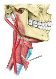 11 Szyja Mięśnie szyi gardło krtań Zmienność przebiegu tętnicy szyjnej wewnętrznej Liniowy gerader przebieg Verlauf t. szyjnej der A.