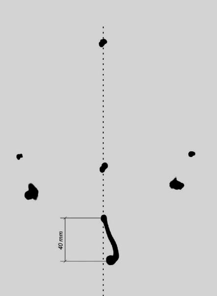 Effectiveness of Physiotherapy in TMJ Dysfunctions 83 Fig. 12. Example analysis of one patient s movement trajectory during abduction of the jaw (frontal plane) Ryc. 12. Analiza trajektorii ruchu żuchwy na przykładzie wybranego pacjenta podczas odwodzenia (płaszczyzna czołowa) Fig.