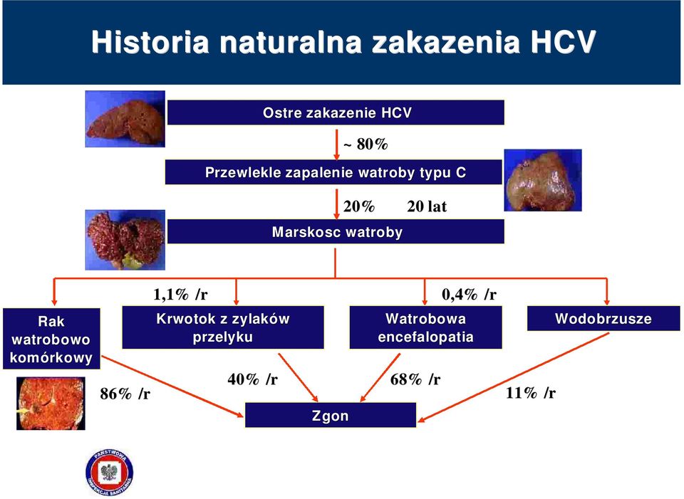 watroby Rak watrobowo komórkowy 86% /r 1,1% /r 0,4% /r Krwotok z