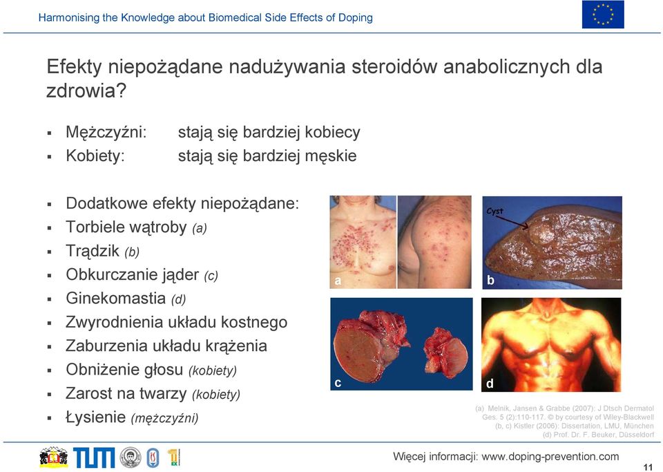 Obkurczanie jąder (c) Ginekomastia (d) Zwyrodnienia układu kostnego Zaburzenia układu krążenia Obniżenie głosu (kobiety) Zarost na twarzy