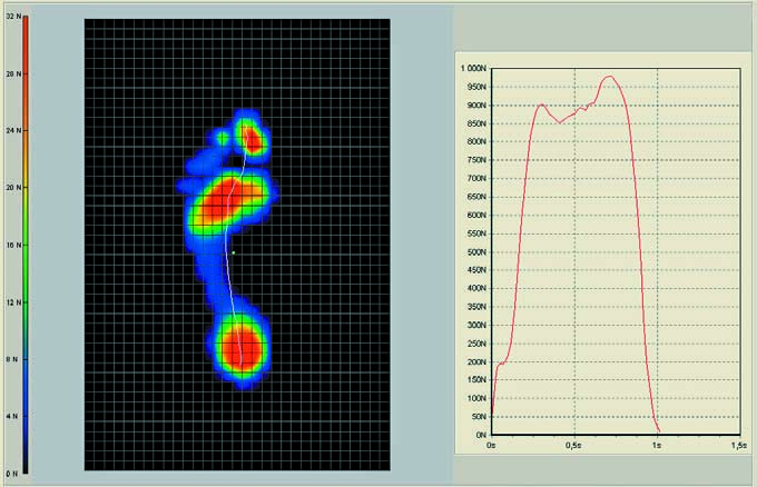 DIAGNOSTYKA rehabilitacja // 1 2 Fot. 1. Obraz badania podoskopowego Fot. 3. Obraz badania statycznego na podobarografie Fot. 4. Obraz badania dynamicznego na podobarografie Fot. 2. Badanie przeprowadzone za pomocą podoskopu komputerowego gnięcie więzadeł, które stabilizują łuk poprzeczny.