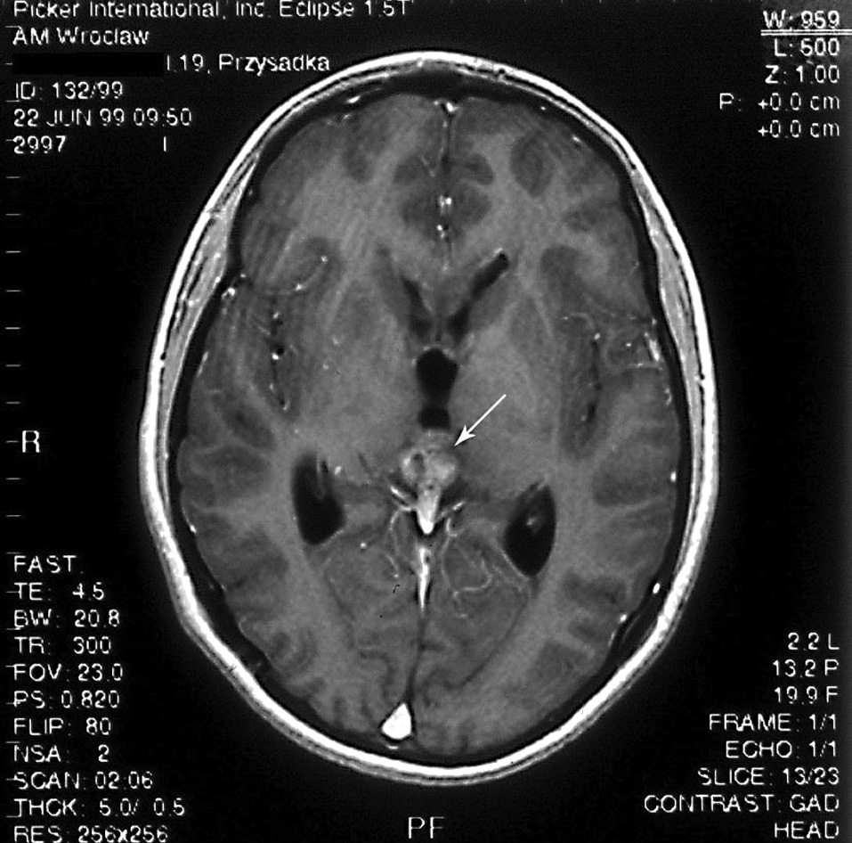 Przypadek rozrodczaka podwzgórza i szyszynki Grażyna Bednarek-Tupikowska i wsp. A B Rycina 1. A. Badanie MRI.