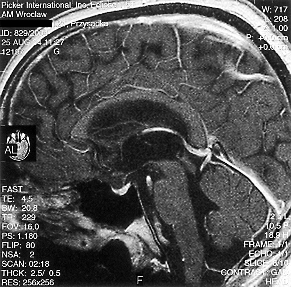 Endokrynologia Polska/Polish Journal of Endocrinology 2007; 58 (5) Rycina 2. Kontrolne badanie MRI wykonane wykazuje całkowitą regresję zmian w okolicy podwzgórza i szyszynki Figure 2.