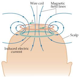 Stymulacja przezczaszkowa Prąd elektryczny płynący przez specjalnie ukształtowaną cewkę powoduje powstanie ukierunkowanego pola magnetycznego.