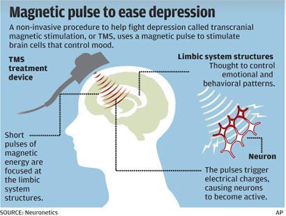 Leczenie depresji stymulacją Krótkie impulsy magnetyczne ukierunkowane na struktury układu limbicznego hamują go