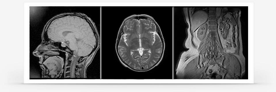 Obrazy MRI Od lewej: - obraz pokazujący przekrój strzałkowy (płaszczyzna pionowa) przez środek głowy człowieka;
