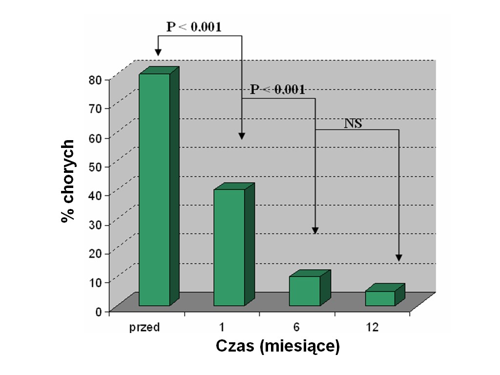 Rycina 10. Częstość występowania duszności przed i po zabiegu zamknięcia ASD II Uczucie kołatania serca występowało u 17 (48,6%) chorych przed zamknięciem ubytku.