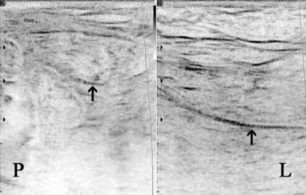 Abdominal integument atrophy after operative procedures Ryc. 5. Wyraźna redukcja masy powłok brzusznych po stronie prawej (P) po appendektomii Fig. 5. Pronounced abdominal integument mass reduction on the right side (P) after appendectomy Ryc.