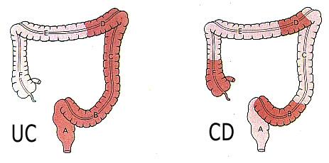 Inflammatory Bowel Disease (IBD) - nieswoiste zapalenie jelit Ulcerative colitis - Wrzodziejące zapalenie