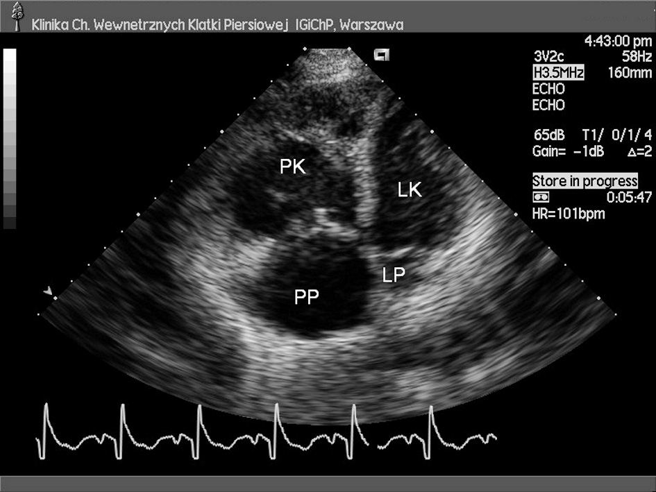 Michał Florczyk i wsp., Zaostrzenie prawokomorowej niewydolności serca w TNP Rycina 1. Badanie echokardiograficzne przez ścianę klatki piersiowej.
